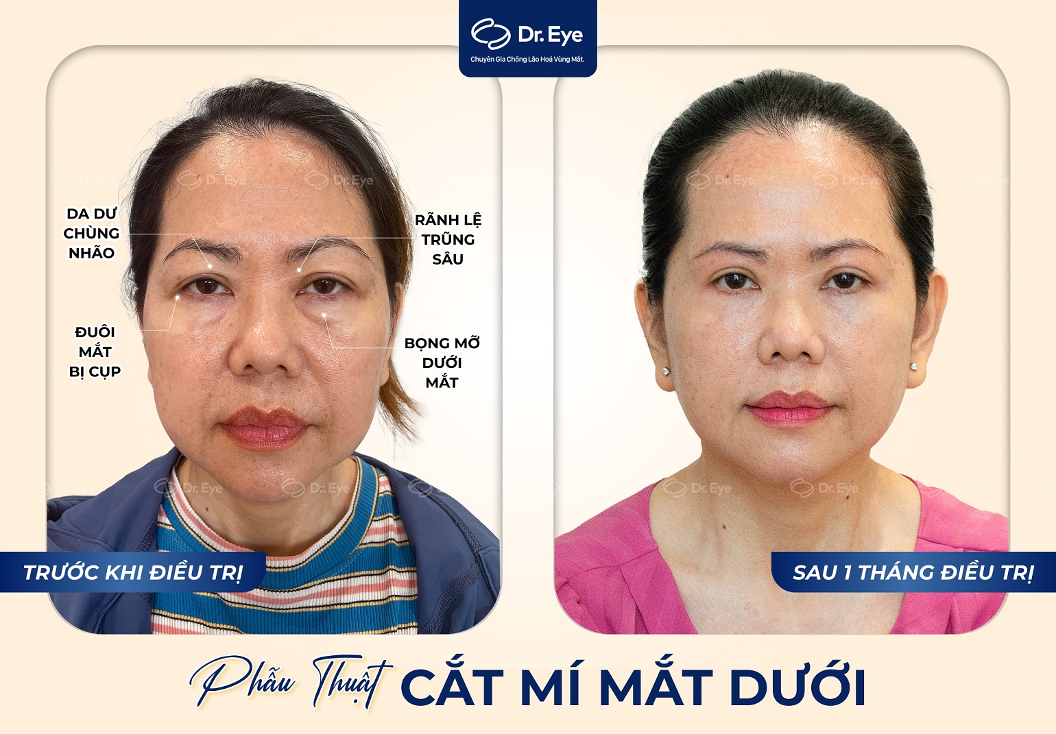 Tình trạng sụp mí, mí lót, hai mí không đều – vấn đề thẩm mỹ mắt cần điều trị